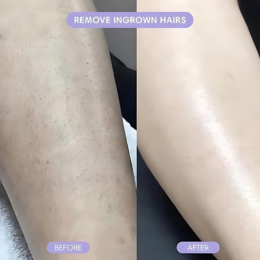 Easy, Smart Painless Hair Removal. Hair Free Skin 💖